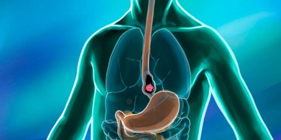 Esophageal Cancer